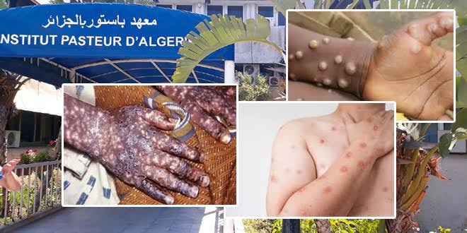 MPOX: L’Algérie se « confine » de l’extérieur Mpox : L'Algérie prend les devants