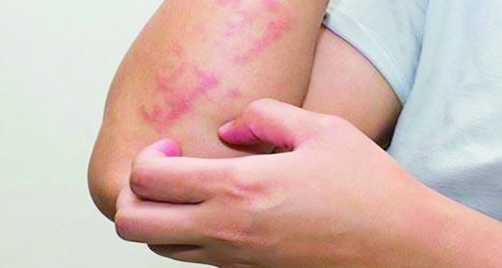 Annaba : Flambée de la gale dans les écoles ! Une épidémie de gale frappe les établissements scolaires et écoles à Annaba, où les autorités sanitaires locales appellent à la vigilance.