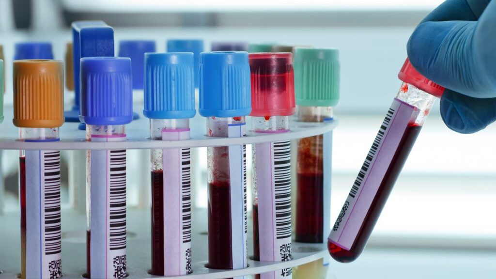 La plupart des laboratoires d'analyses médicales en Algérie traversent actuellement une période critique. La cause : les produits réactifs font cruellement défaut. Il ne s'agit plus de simples perturbations, mais littéralement de pénurie.